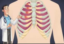 Costochondritis and anxiety