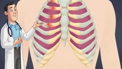 Costochondritis and anxiety