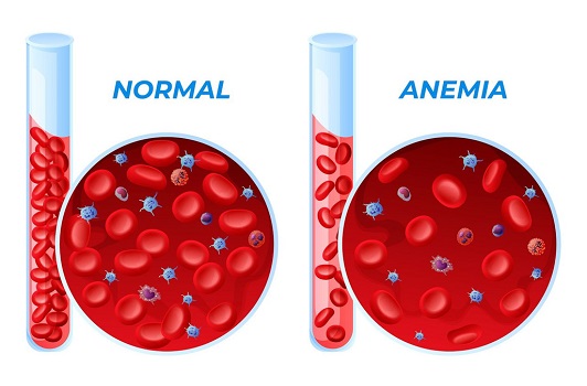 anemia-vs-low-iron-similarities-and-faqs