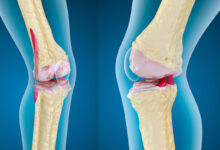 Difference between osteoarthritis and rheumatoid arthritis