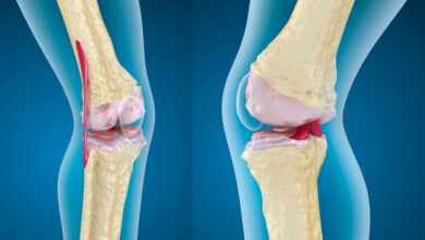 Difference between osteoarthritis and rheumatoid arthritis