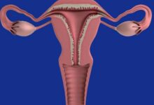 Polyps and Fibroids