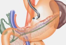 Difference between gastroscopy and endoscopy